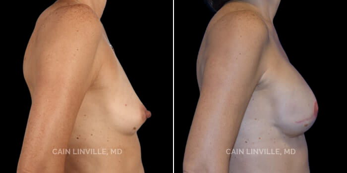 This petite 55 yo woman developed breast cancer and underwent a classic two-stage implant-based approach, using a Tissue Expander at the time of her skin-sparing mastectomy, placed in the pre-pectoral plane, and then eventually having them replaced for an implant along with fat-grafting. Tissue expanders were initially chosen because the patient wanted to have a slightly larger breast than when she started, and the tissue expander was used to help increase the size of the breast skin envelope. Her final implants are tear-drop shaped, anatomic implants. Finally, she had nipple reconstruction followed by 3-D areola tattooing. Her results show what can be achieved on a small frame and also demonstrate a very well done areola tattoo for a great overall result, shape, and look.