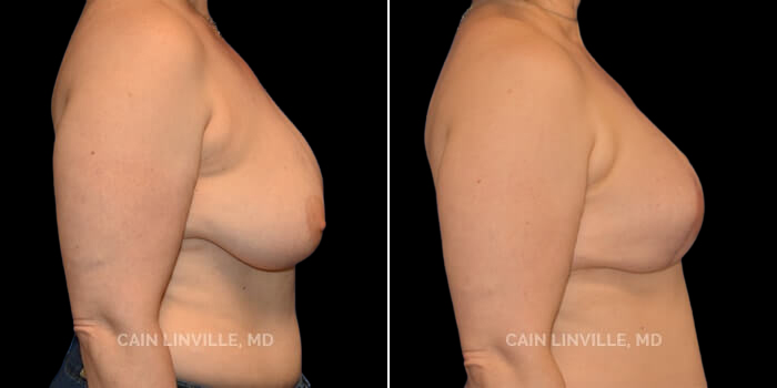 This patient is also a young, 45 yo woman who was BRCA positive, but not a candidate for flap surgery. She instead had bilateral skin-sparing mastectomies, pre-pectoral tissue expander placement, followed by placement of implants along with fat-grafing. Although implant-based, she has a great breast shape and silhouette. Her nipple was created later and then she had tattooing, which gives her a great look and appearance.