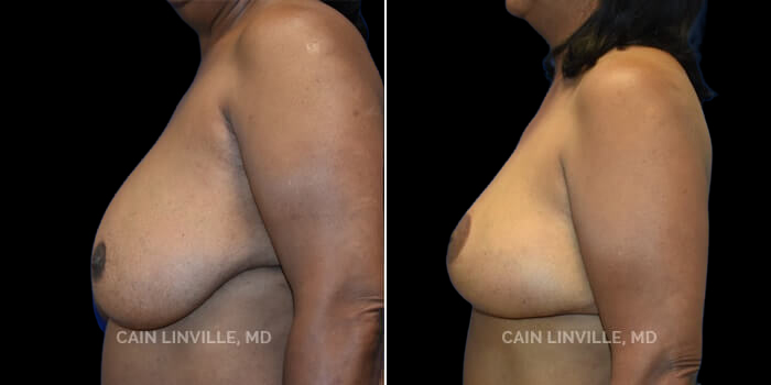 60 yo woman who underwent 3-stage reconstruction. Preoperatively, she had significant breast ptosis, but was a nipple-sparing candidate otherwise. Thus, she had a lumpectomy, with bilateral oncoplastic reduction. Next she had bilateral nipple-sparing mastectomies, and simultaneous DIEP flaps for reconstruction. Lastly, she had a revision, with fat grafting. Her end result is identical to a mastopexy, but instead what is under her breast skin envelope is her previous abdominal tissue! Her scar result, mimicking a mastopexy and tummy tuck, is phenomenal, and she is extremely happy.