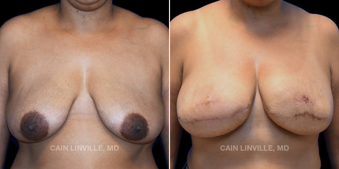 48-year-old female underwent reconstructive surgery. Bilateral DIEP flap with fat grafting and nipple reconstruction.