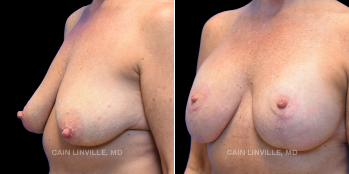 This patient desired a lift with a slight increase in size while still achieving a natural look. She is 51 years old and received a breast lift with implants of size 360cc. These photos are 4 months post op.