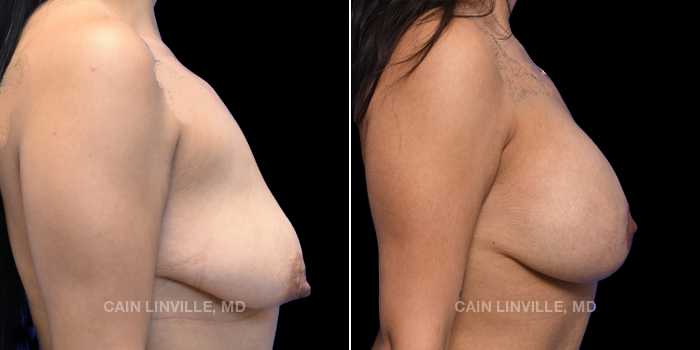 Patient 12 Right Side View Breast Lift Linville Plastic Surgery