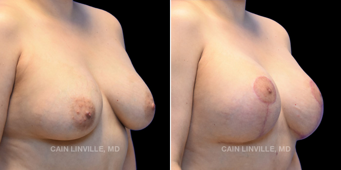 Patient 11 3/4th Right Side View Breast Lift Linville Plastic Surgery
