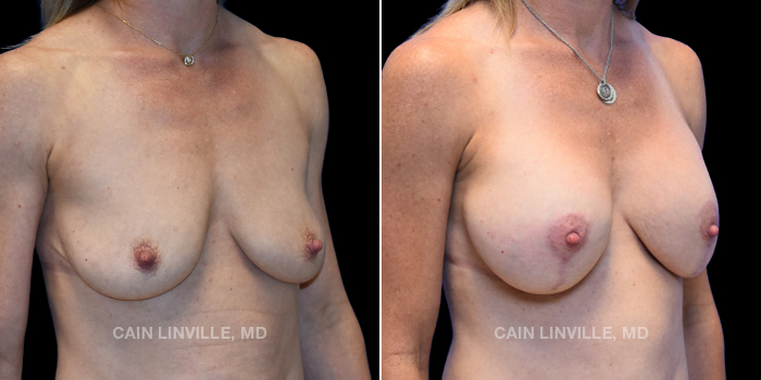 This patient is a 41 year old female who received a breast lift with implants. These photos are 3 months post op.