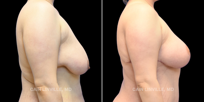 28 years old Procedures Depicted Breast lift no implants