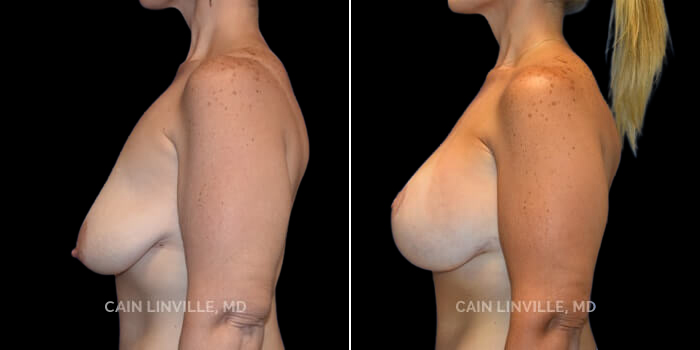 This patient is a 41 year old female who received a breast lift with implants. These photos are 4 months post op.