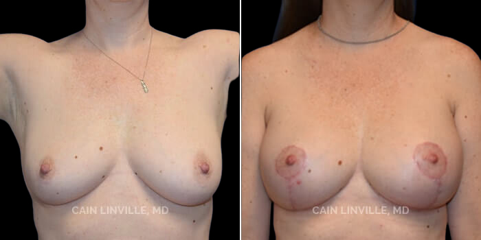 Patient 1 Front View Breast Lift Linville Plastic Surgery