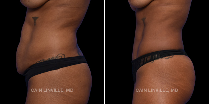 This patient is a 43 year old female who received a tummy tuck in combination with lipo 360 and bodytite with a hernia repair. These photos are 5 months post op.