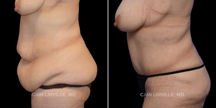 This patient is a 48 year old female who received a tummy tuck in combination with liposuction. These photos are 1 year post op.