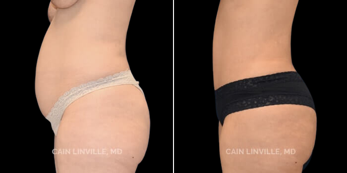 This 40 year-old mother of 2 had fairly severe rectus diastasis and excess skin, along with excess adipose. Her goal was to have a flat tummy and to feel sexy again. She underwent a lipoabdominoplasty as part of her mommy makeover, including rectus plication, and breast aug/lift (not shown here). She has a great result, with a low scar, and a nice belly button, and additionally, an enhancement of her lateral abdominal musclular shadow, due to a subtle amount of abdominal etching that was performed.