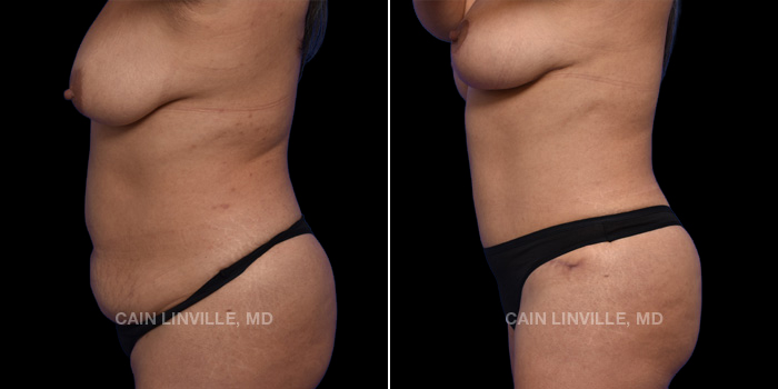 This patient is a 46 year old female who received a tummy tuck in combination with liposuction 360, a breast lift, and bodytite. These photos are 3 months post op.