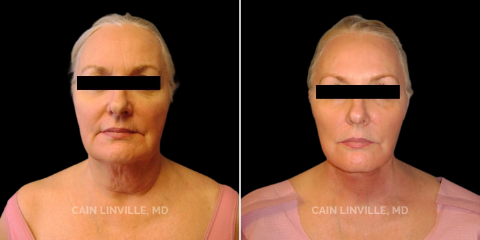 Patient 01 Front View Face and Neck Lift Linville Plastic Surgery