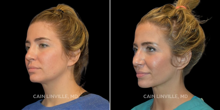 This young woman desired an improved, rejuvenated appearance of her submental contour and face. FaceTite to the neck and lower face, along with submental lipo, and fat grafting to the cheeks, lower lids, and temples was performed to achieve a very natural look with an ideal neck contour. This was all done with the patient awake, and was well-tolerated. The enhanced cheek contour along with improved neckline and contour give an extreme but natural change in appearance.