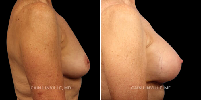 Patient 10 Right Side View Breast Augmentation Linville Plastic Surgery