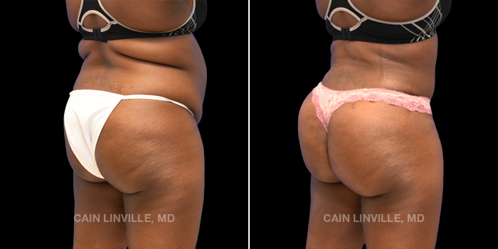 40 year old underwent tummy tuck with liposuction to abdomen and flanks. Brazilian buttock lift with 470 cc injected on each side to improve projection and shape.