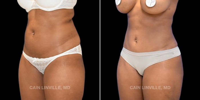34-year-old underwent mini tummy tuck, liposuction to abdomen, flanks, back, bra area, and outer thighs with bodytite. Fat grafting to buttocks of 450 cc injected on each side for more volume and shape. Breast Augmentation of 485cc silicone smooth cohesive implants.
