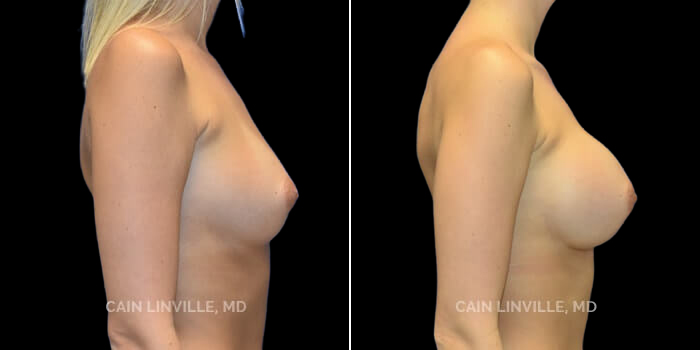 This beautiful patient wanted a subtle but noticeable increase in her breast size and fullness, from a B to a D cup. We chose a 345 cc Soft Touch Cohesive round implant, placed through an infra-mammary incision since she is young and might want to breast feed. She has settled perfectly and has the ideal postop shape and contour.