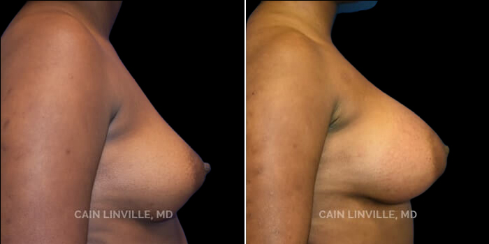 This is a 45 year-old mother of two, who desired a breast augmentation and a full look with upper pole fullness. She wanted to go from a small C cup to a large D cup. 420 cc gummy bear implants, dual plane I pocket. She has a great post-op outcome without capsular contracture, and good symmetry. She has excellent upper pole fullness without significantly widening the chest. She is also now extremely confident with her new look and loves the shape and size.