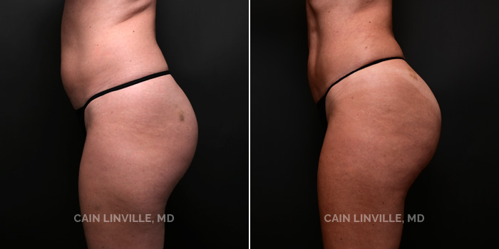 This patient is a 38 year old female who received liposuction with bodytite to her abdomen and back. Brazilian buttock lift to help shape and contour her silhouette. These photos are 4 months post op.