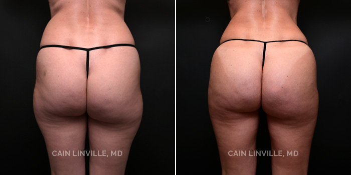 This patient is a 38 year old female who received liposuction with bodytite to her abdomen and back. Brazilian buttock lift to help shape and contour her silhouette. These photos are 4 months post op.