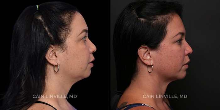 facetite before and after patient image