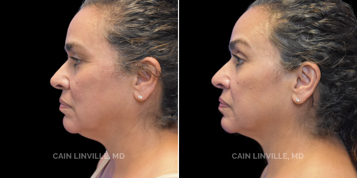 facetite before and after patient image