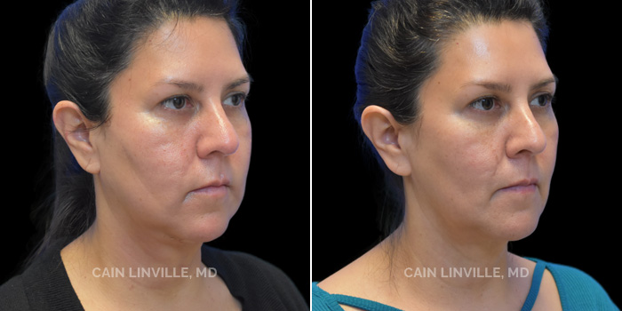 48 year old patient, who underwent FaceTite, Accutite, and Lipo of Submental area, followed by a series of Morpheus8 treatments to tighten skin further. These photos are 5 months post-op.