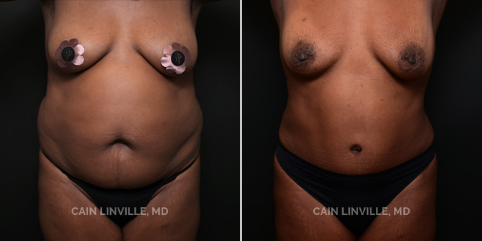 A 49 year old female wanted to get back to her pre-mommy body after having 5 children. She had a abdominoplasty with lipo 360 w/BT and added lipo/BT inner thigh.