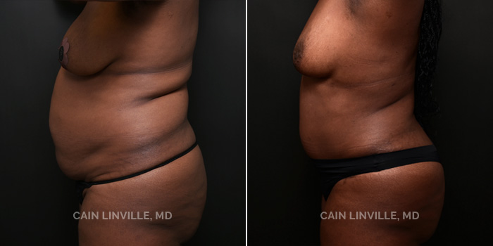 A 49 year old female wanted to get back to her pre-mommy body after having 5 children. She had a abdominoplasty with lipo 360 w/BT and added lipo/BT inner thigh.