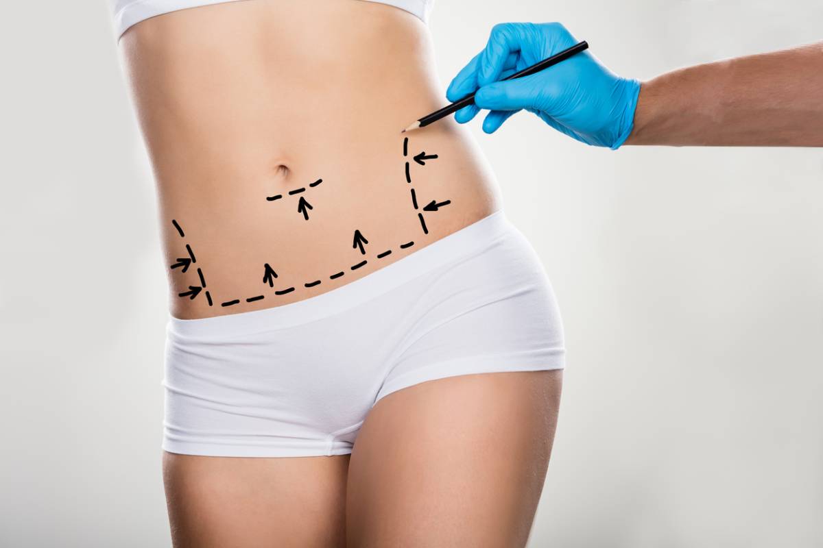 featured image for sun exposure after tummy tuck