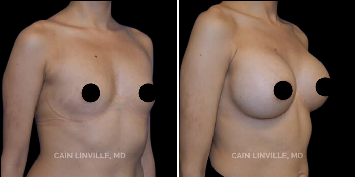 before after augmentation with fat transfer procedure patient 1b