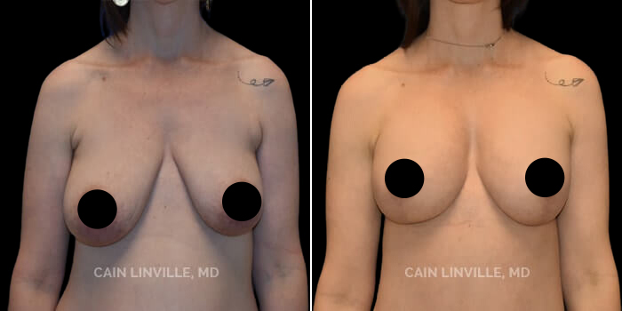 before after breast asymmetry procedure patient 1a