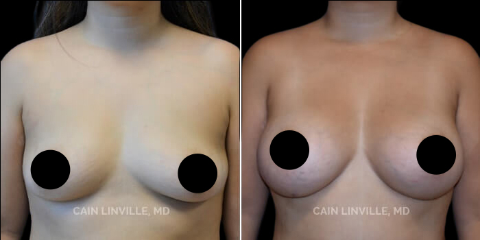 before after breast asymmetry procedure patient 1b
