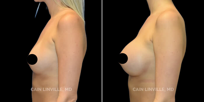 before after breast augmentation procedure patient 1b