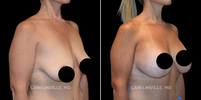 before after breast lift procedure patient 1a