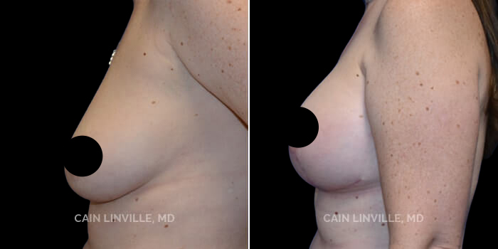 before after breast lift procedure patient 1b