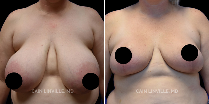 before after breast reduction procedure patient 1a