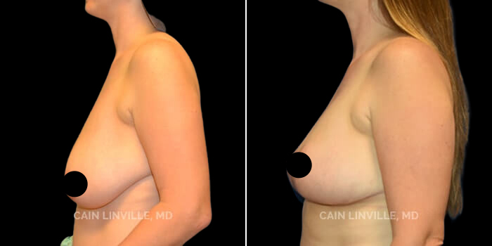 before after breast reduction procedure patient 1b