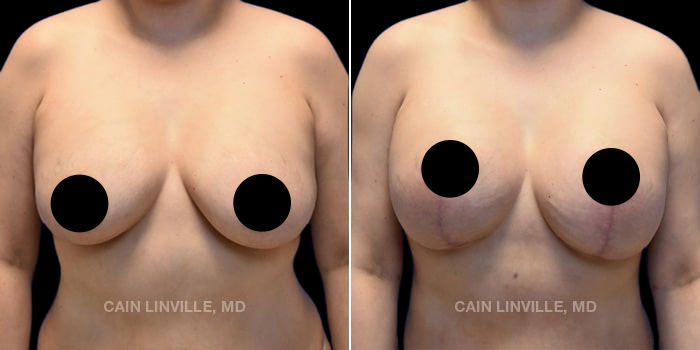 before after breast revision procedure patient 1a