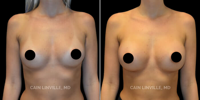 before after nipple and areola surgery procedure patient 1a