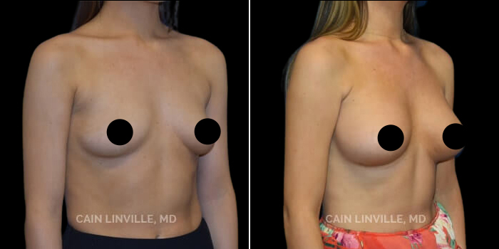 before after nipple and areola surgery procedure patient 1b