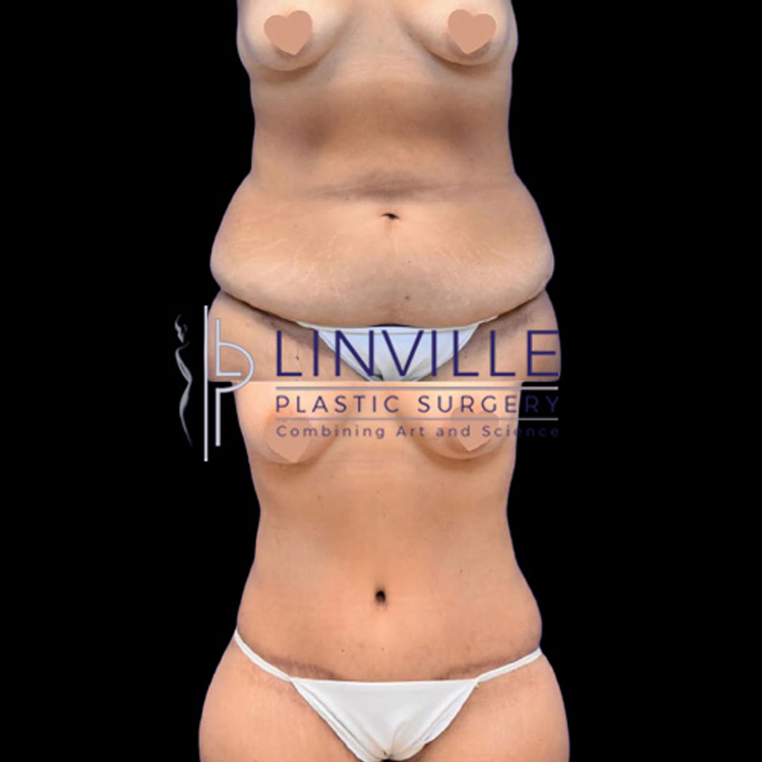before after tummy tuck procedure patient 1