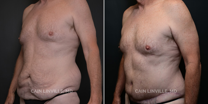 This 56 year old male received a tummy tuck, lipo/BodyTite 360, pubis and chest, and fat grafting to the buttocks. These photos are 1 year post-op.